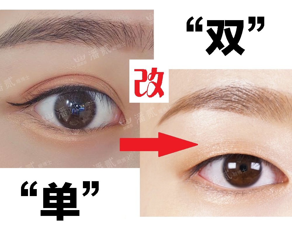 眼角下垂做双眼皮手术可以改变吗,后悔做双眼皮