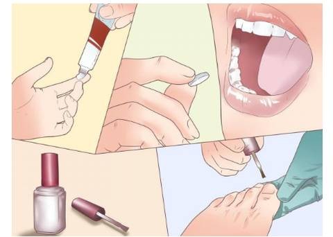 灰指甲真的治不好吗,灰指甲是不是治不好