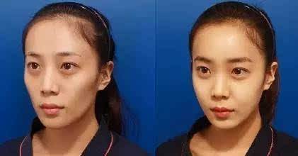 脸颊胶原蛋白补充,脸颊凹陷胶原蛋白流失如何补过来