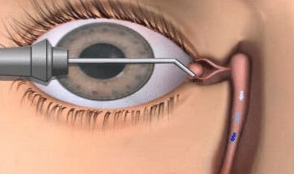 幼童一只眼睛无缘无故流眼泪,眼睛总是无故流眼泪是什么原因