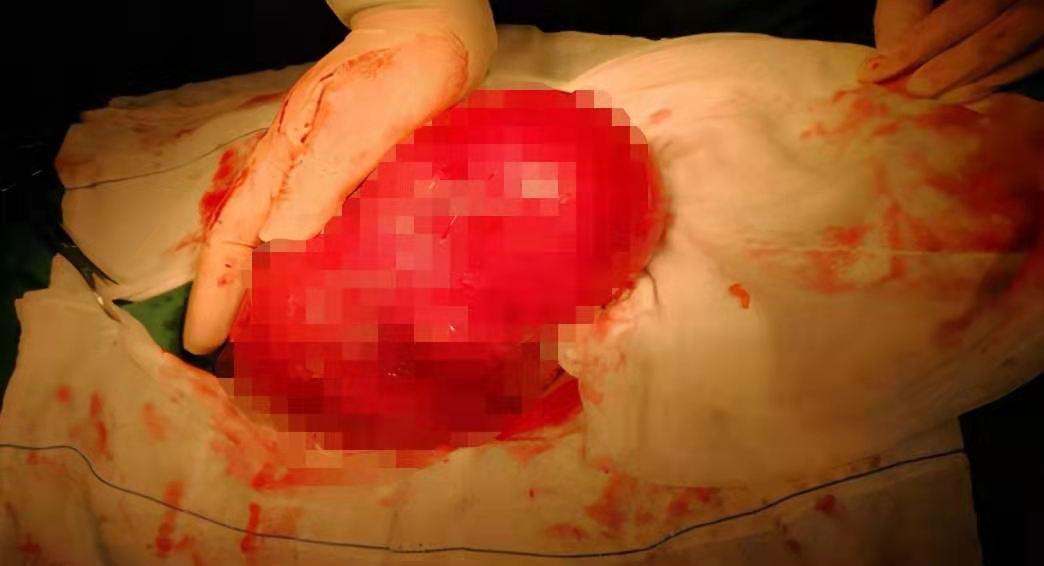 子宫肌瘤切不切有什么影响,切子宫肌瘤和切卵巢哪个伤害大