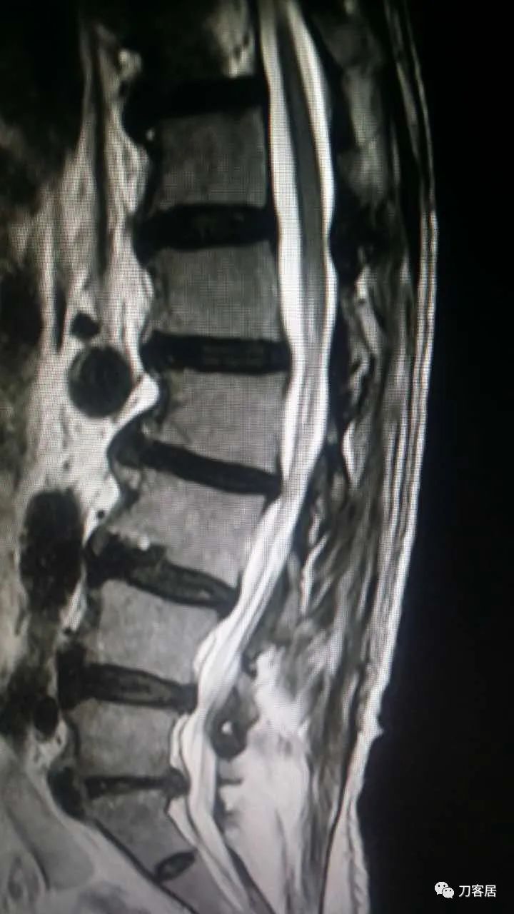 腰椎手术切掉棘突,腰突微创后出血肿