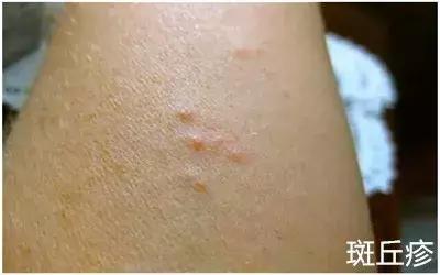 6种儿童常见皮肤病的鉴别指导,孩子容易出现的皮肤病你了解多少