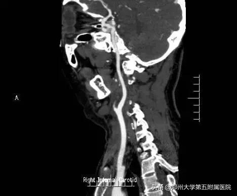 鼻咽癌导致颈部包块是早期吗,颈部包块怎么治疗最好
