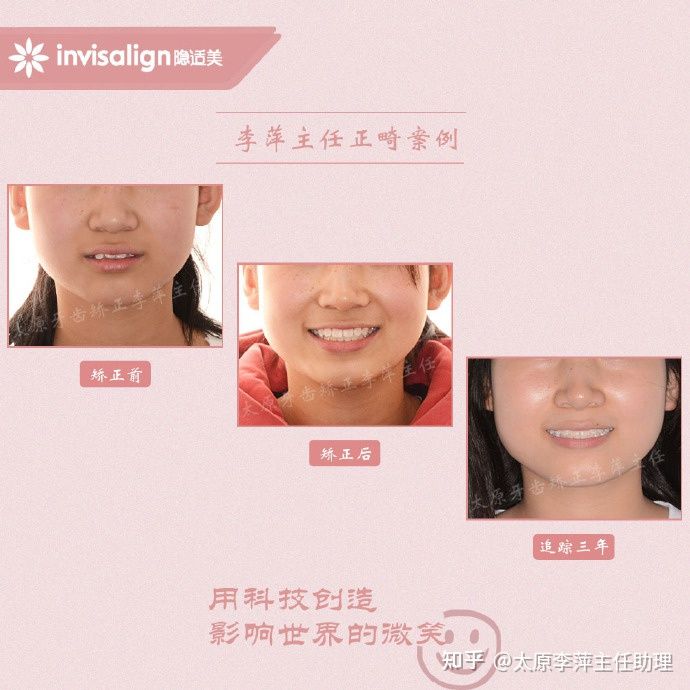 太原市牙齿正畸,太原市口腔正畸