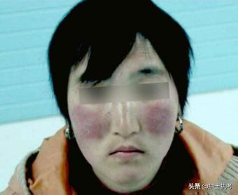 执业医师技能考试心脏瓣膜病真题,风湿性心瓣膜病护考习题