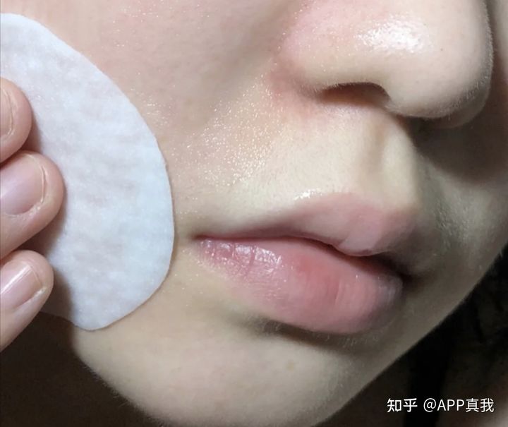 刷酸后黑头变多，用手挤黑头会不会有影响？