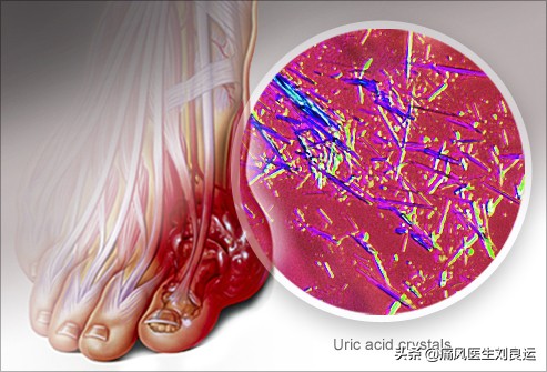 降尿酸过程中痛风频繁发作,痛风降尿酸过程中反复发作