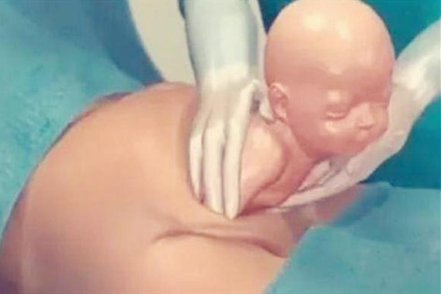 剖腹产肚子上最多能挨几刀,剖腹产完打的肚皮针是什么