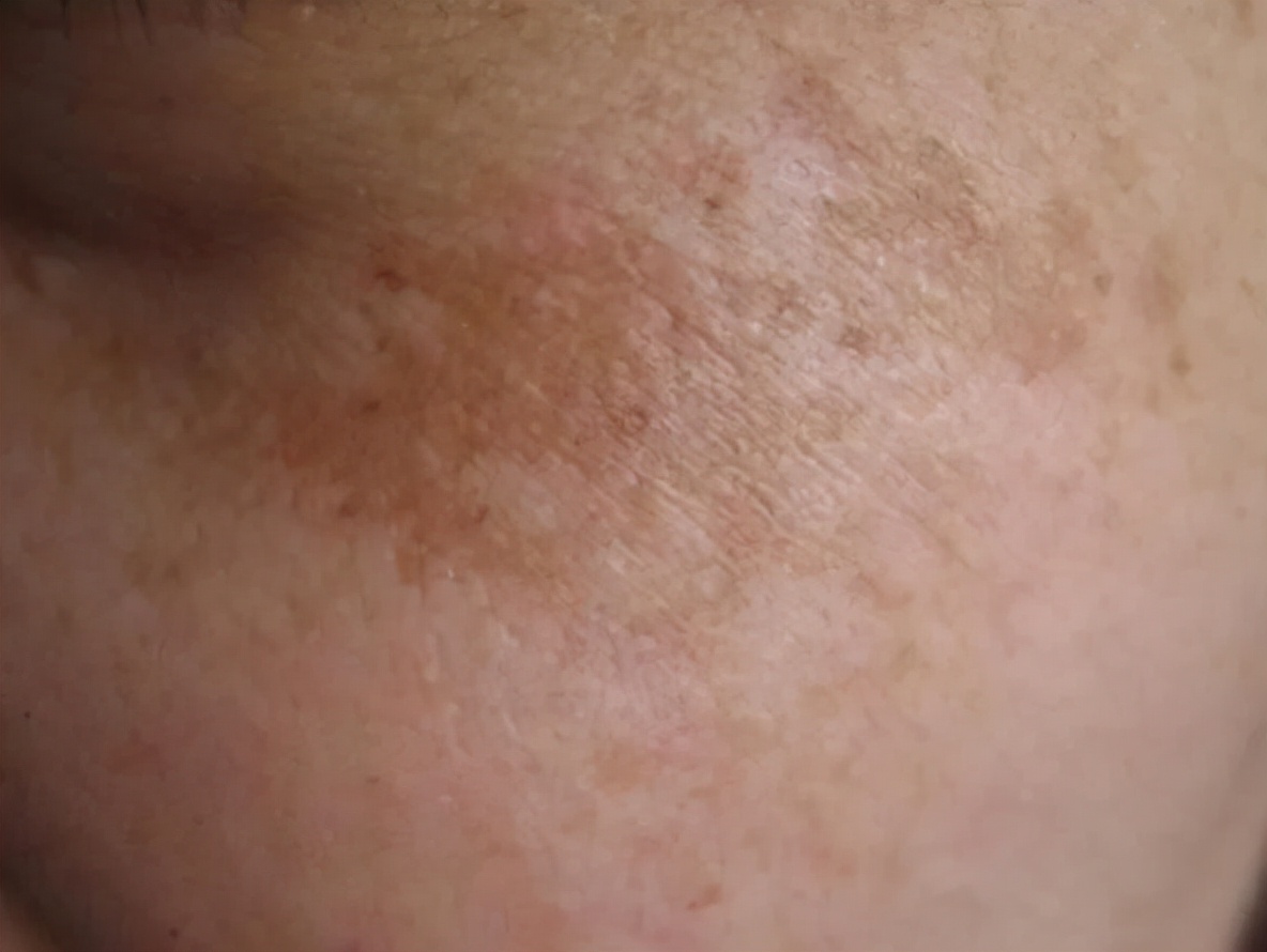 褐斑是怎么引起的,怎么预防长褐斑