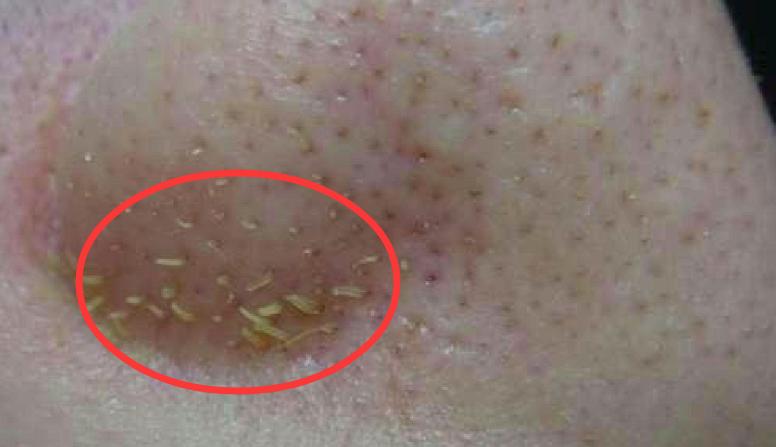 【鼻子最容易挤出这些白色的“条状物”，它到底是什么？】