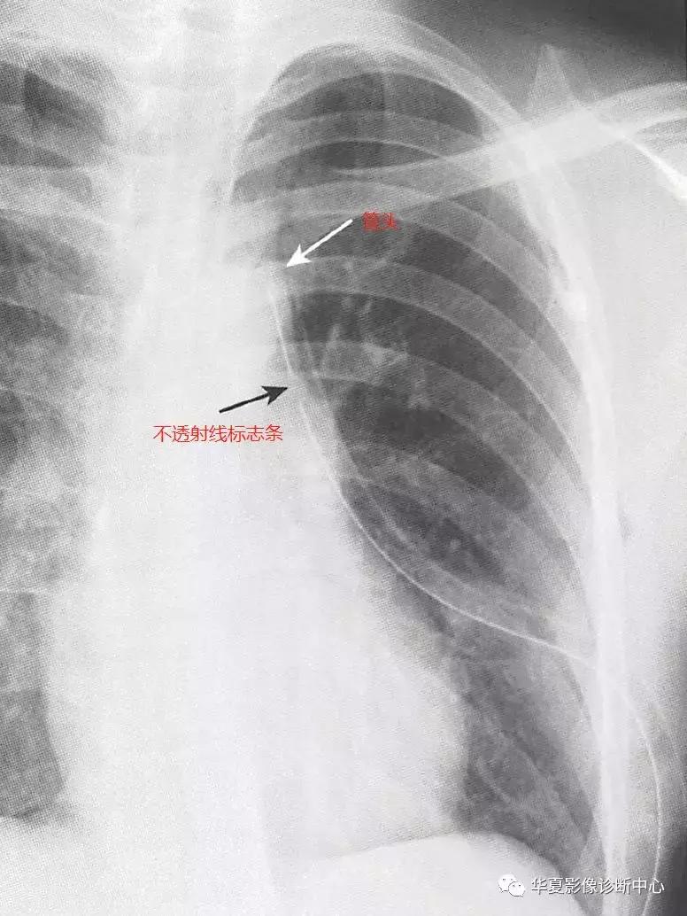 胸部x线影像与诊断基础,胸部置管