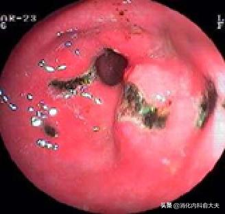看完这篇文章，家里遇到呕血或黑便的人时，我应该可以做得更好