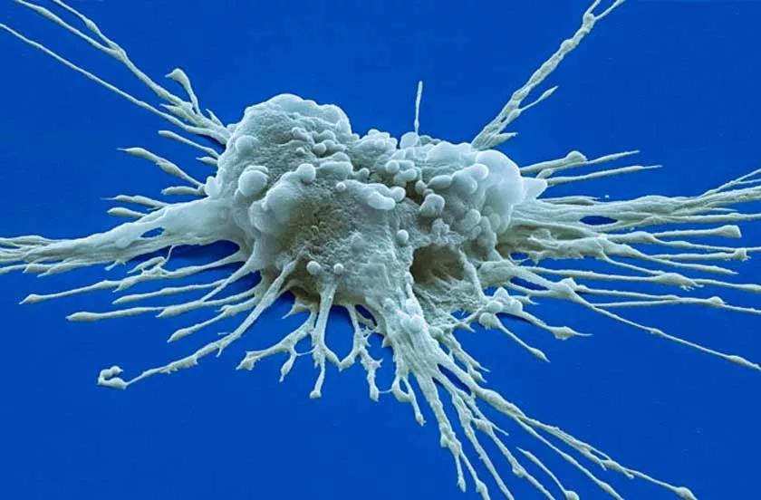 癌症治疗多面手！NK细胞免疫疗法，或将成为晚期癌症治疗最佳选择