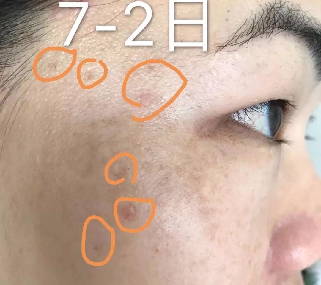 opt祛斑多久能排出色沉,液氮祛斑后色沉严重