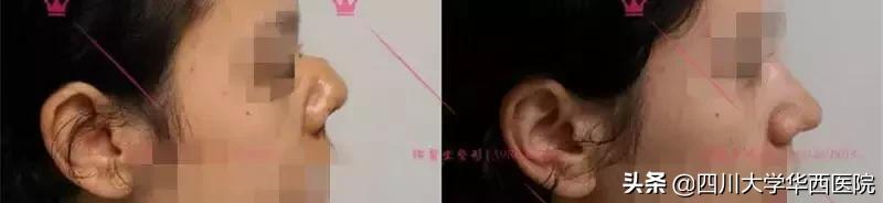 鼻子太翘怎么整形,鼻子太尖整形修复最佳方法