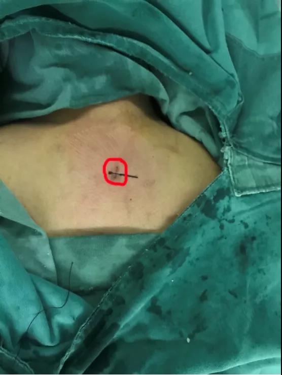 *安泰**市中心医院成功开展颈椎后路内镜“钥匙孔”技术治疗高度游离的颈椎间盘突出症