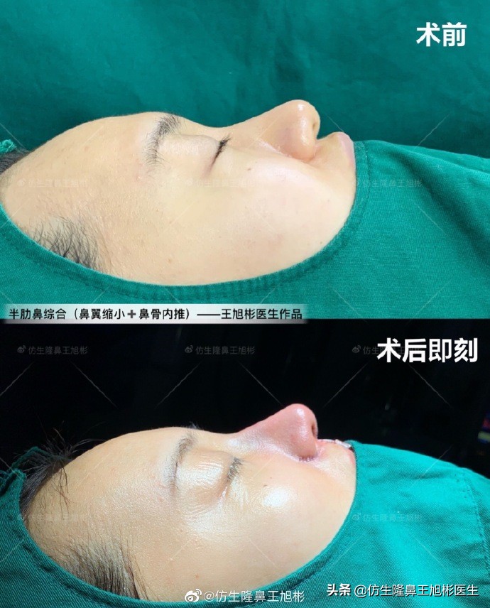 隆鼻鼻型科普,鼻基底凹陷隆鼻可以改善吗