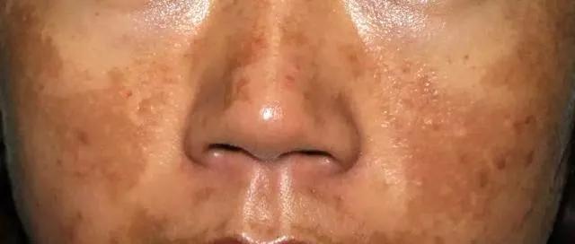 脸上各种斑图解,脸上常见6种斑点图片