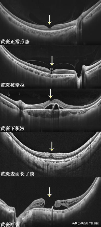 眼睛看不到东西医生说是黄斑病变,最近眼睛里长了黄斑