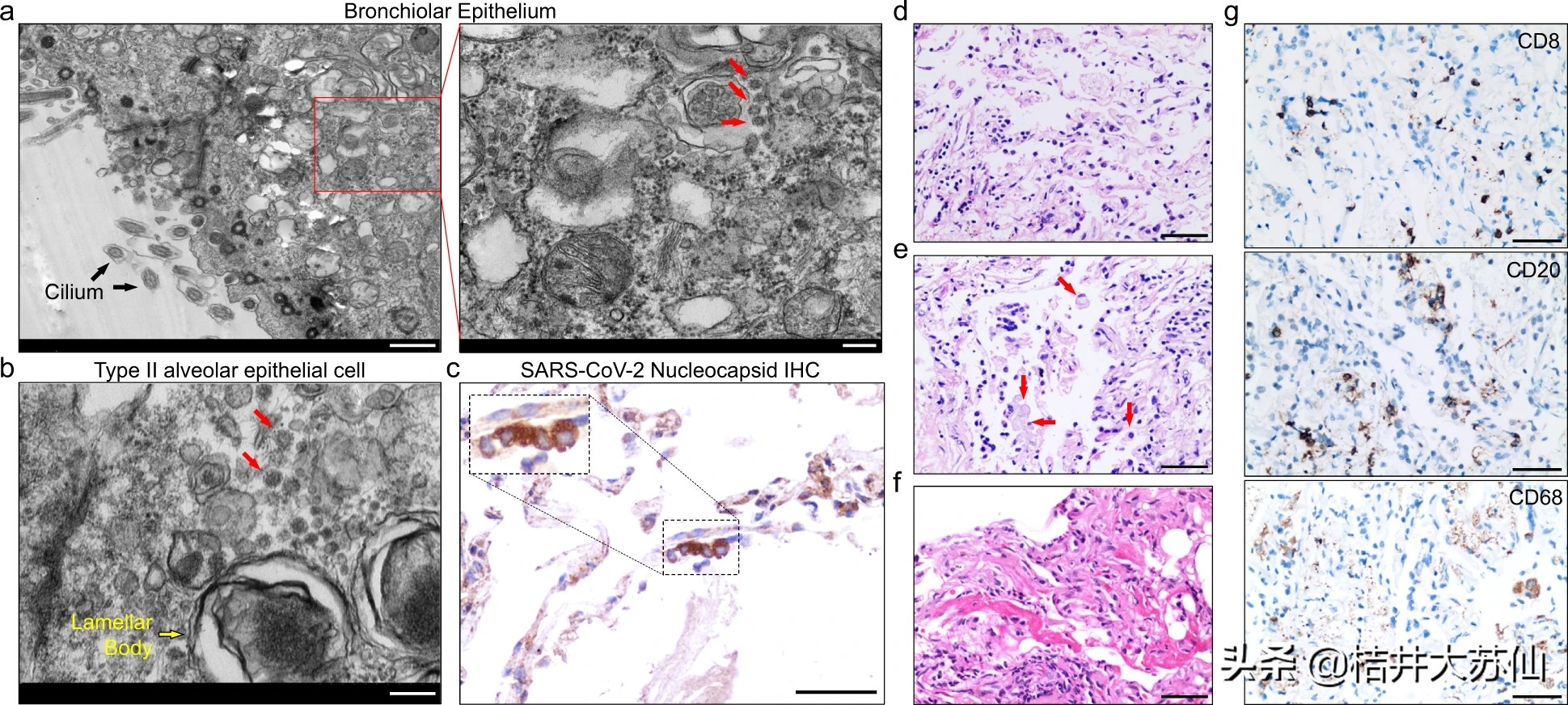 呼吸道三联检测咽拭子是测什么的,三次咽拭子检测