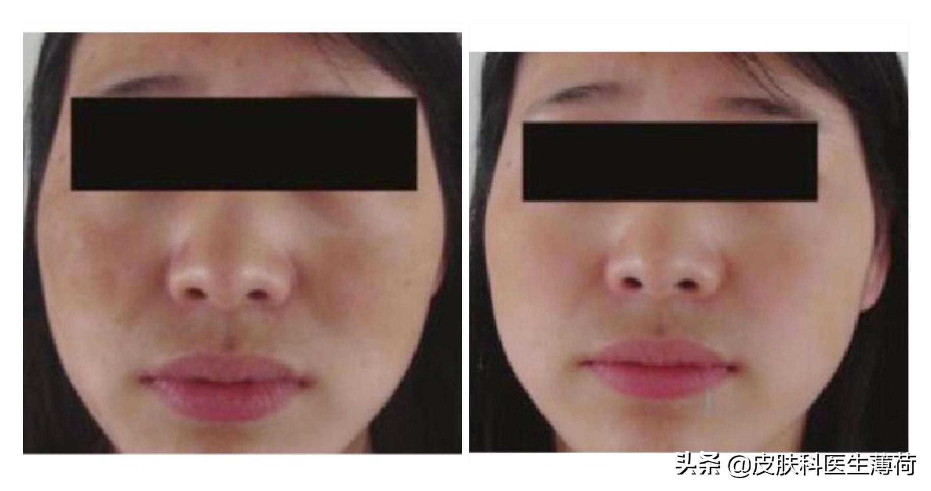 皮秒激光祛雀斑效果图,激光祛痘坑效果