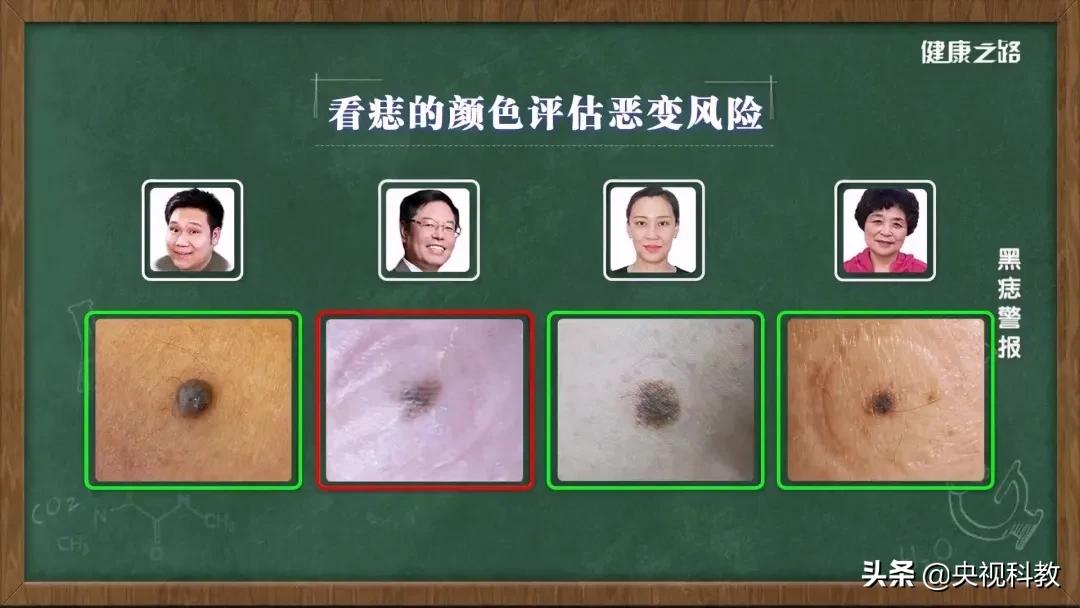 身上的黑痣有癌变的风险吗,身上长黑痣怎样防止恶变
