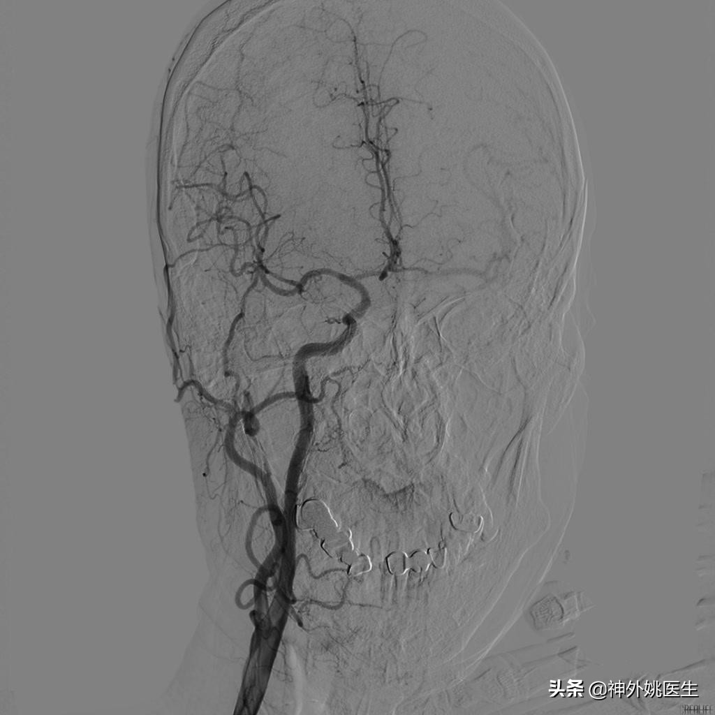 颈内动脉狭窄内膜剥脱术风险大吗,颈动脉内膜摘除手术
