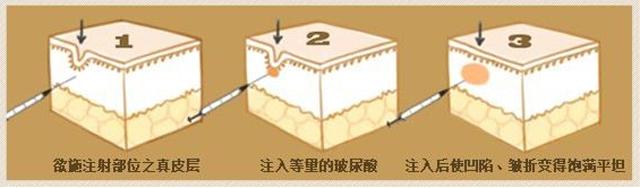 玻尿酸的效果,玻尿酸的美容优势有哪些