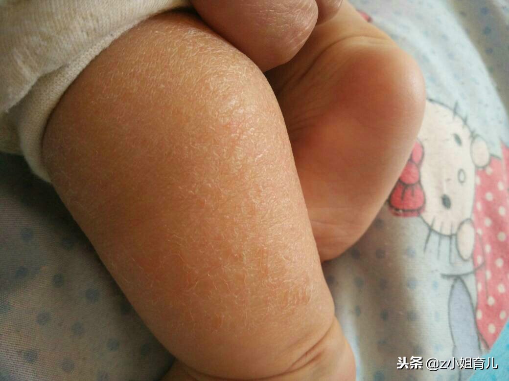 冬天宝宝皮肤干燥有什么办法,冬天宝宝皮肤干燥起皮怎么办