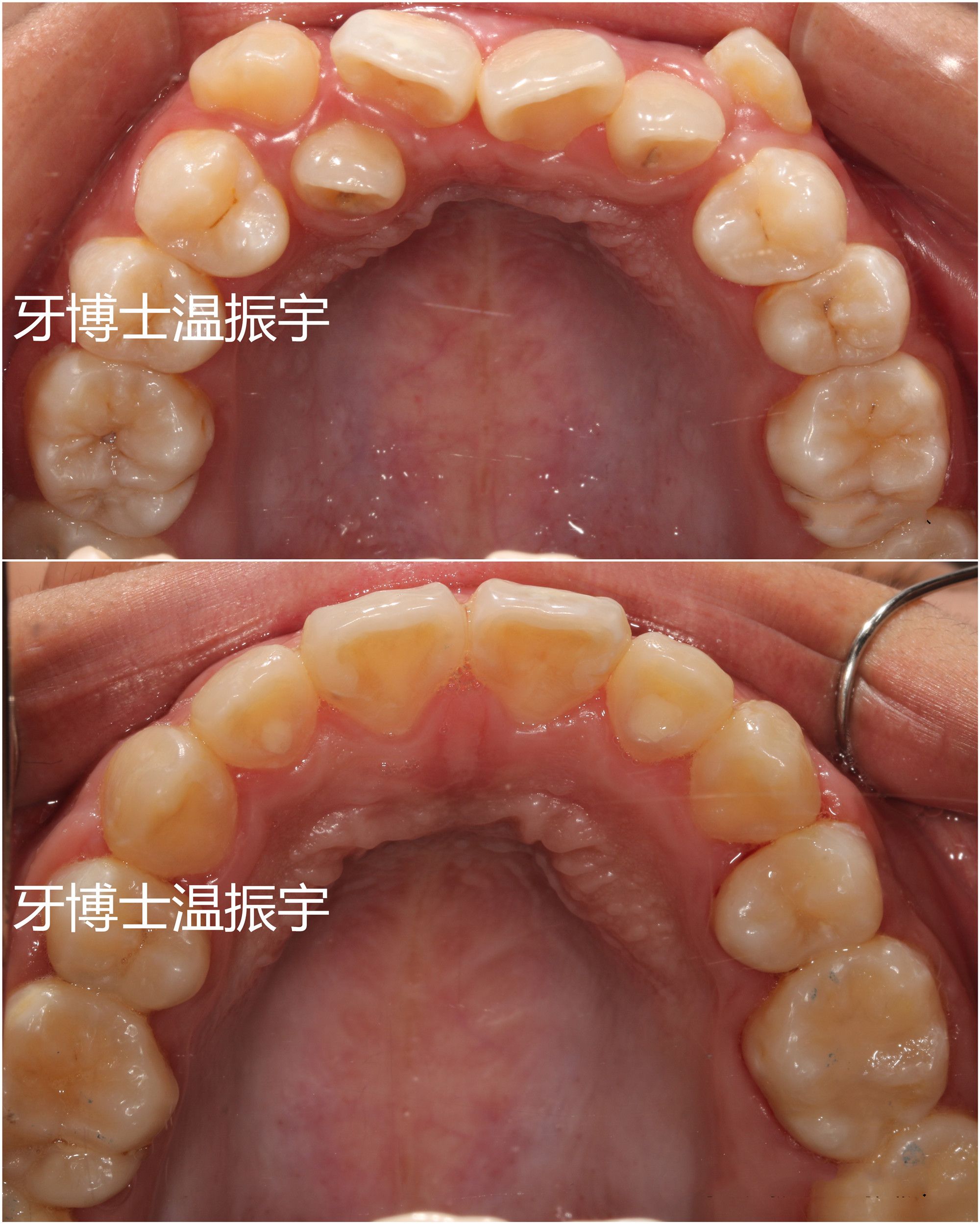30岁还可以牙齿矫正吗,30岁牙齿矫正一般多少钱