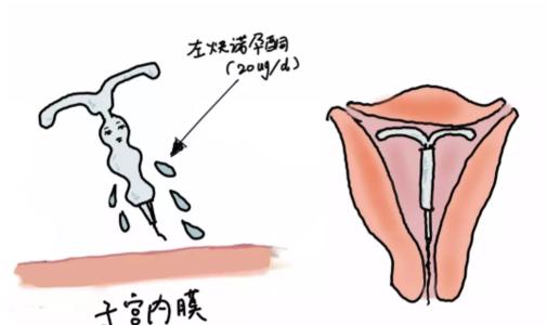 女性避孕方式有几种方法,未婚女性避孕最佳方式
