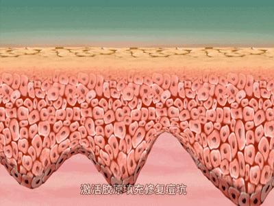 毛孔粗大痘印痘坑修复的护肤方法,有痘印痘坑怎么用护肤品消除