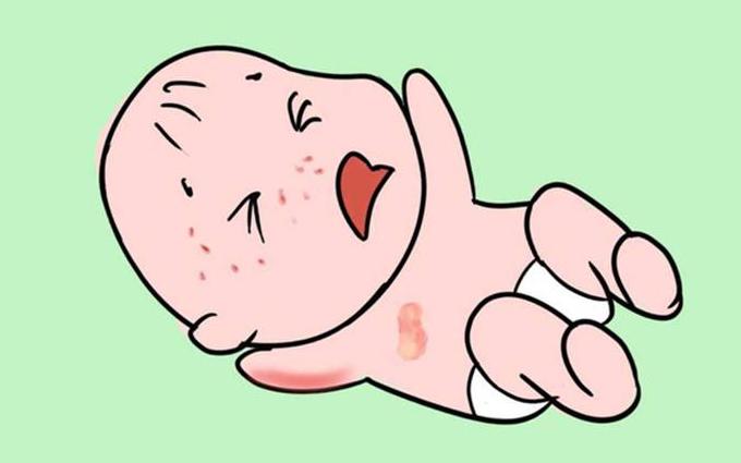 宝宝湿疹怎么办才好得快,宝宝得了湿疹怎么处理好得快