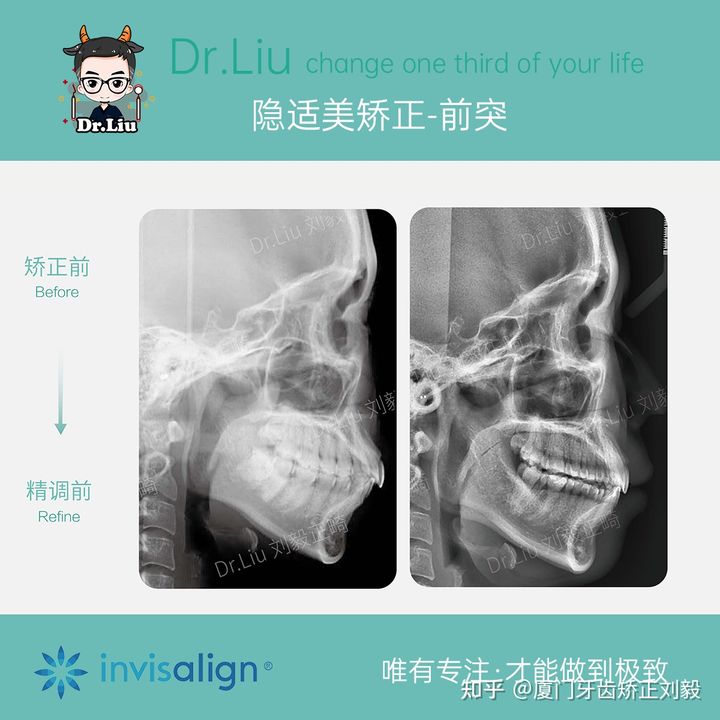 牙齿矫正厦门口腔医院,厦门隐形龅牙矫正优惠