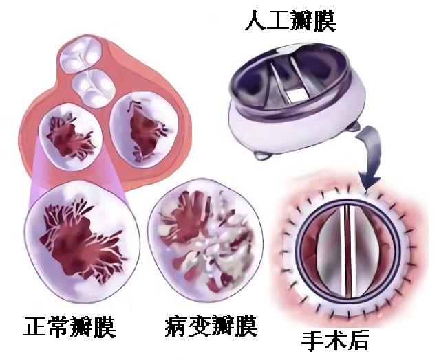 心瓣膜疾病病人的护理,瓣膜性心脏病内科治疗指南