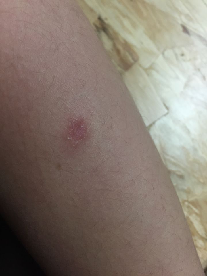 如何才能有效的治好猫癣,人得猫癣怎么治疗才可以根除