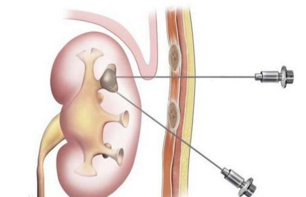 经皮肾镜切开取石术,超微可视经皮肾镜碎石取石术危险
