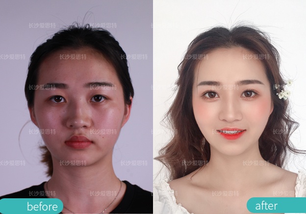 2022年新双眼皮手术多少钱一个月,医院双眼皮手术一次价格