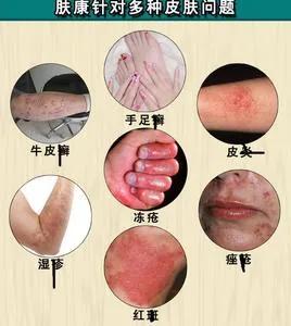 皮肤痒喝什么汤止痒,祛风止痒汤治疗皮肤瘙痒