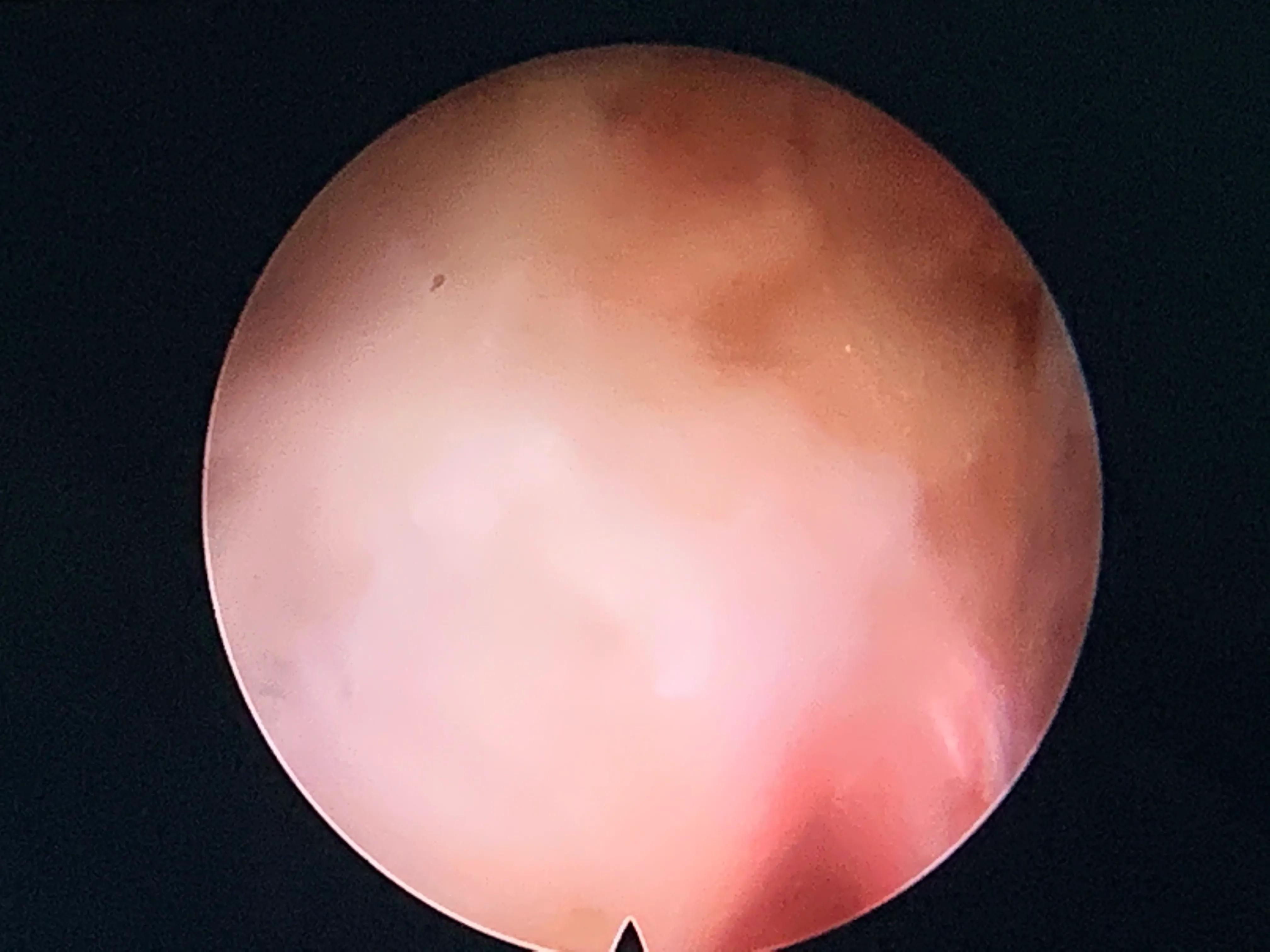 椎间孔镜术后腰痛症状多久消失,盘源性腰痛手术后易复发吗