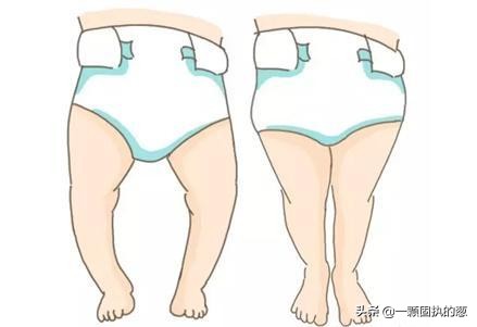 新生儿有o型腿是什么原因造成的,一岁2个月宝宝o型腿绑腿多久能好