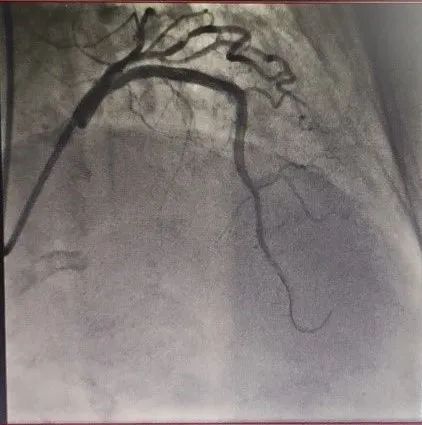 北京积水潭医院心内科成功开展医疗新技术！准分子激光冠脉消蚀术与冠脉旋磨术治疗冠脉钙化病变