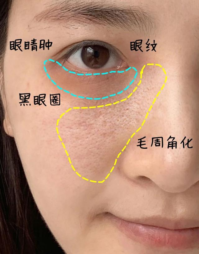 眼睛下面毛周角化症怎么治,眼睛下方毛周角化可以治疗吗