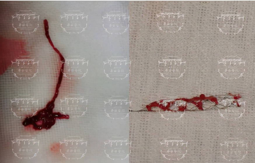 打玻尿酸多久可以移植自体脂肪,打玻尿酸整形有危险吗