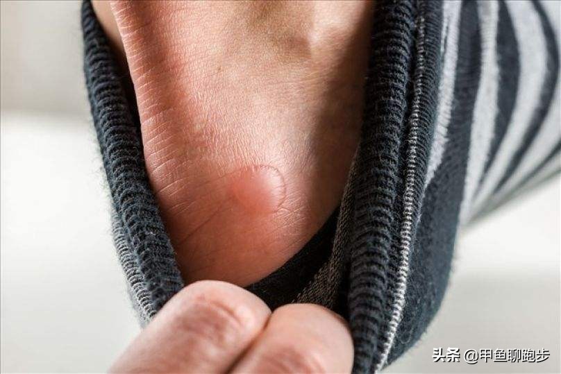 跑步脚起水泡怎么处理好,跑步脚起水泡怎么办