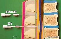 「免疫相关不良妊娠答疑解惑52」——妊娠期高血压疾病