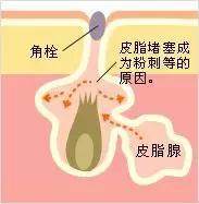 毛孔粗大收缩毛孔最有效方法实测,毛孔粗大收缩毛孔最有效的小妙招
