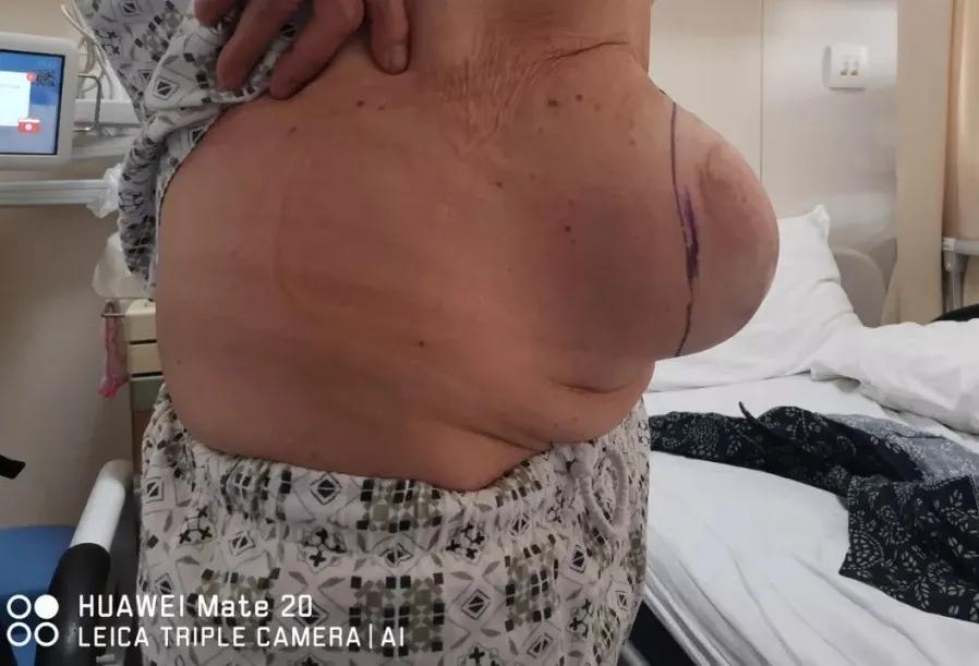 “大爷，你的肠子怎么老往外掉？”