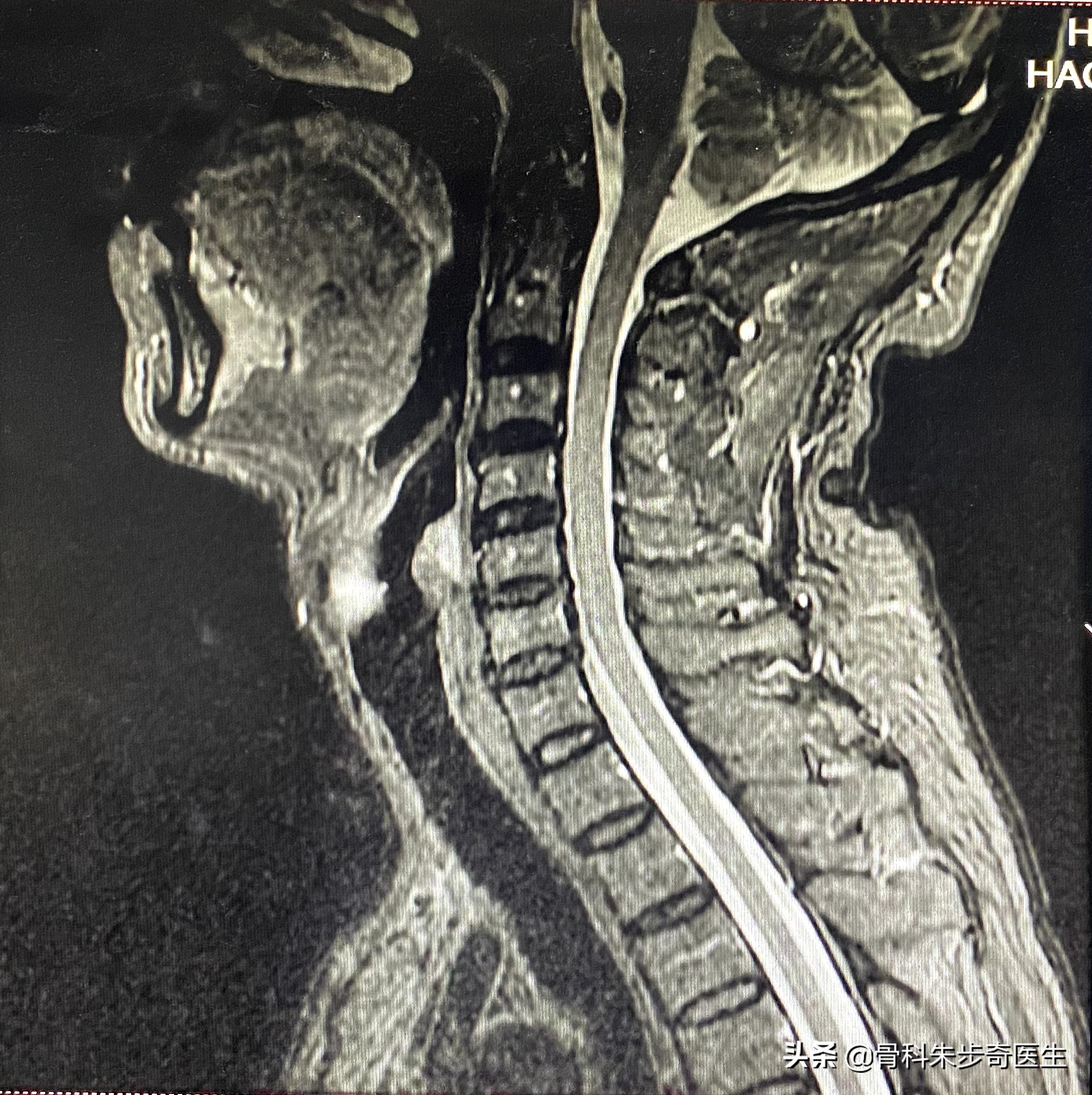 快速辨别手麻是否颈椎病引起,颈椎病手麻是什么原因